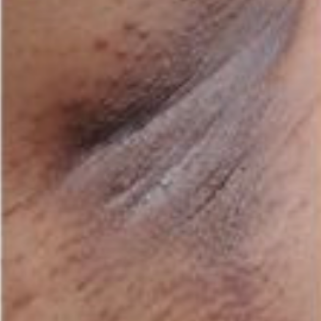 Results After 3 Months