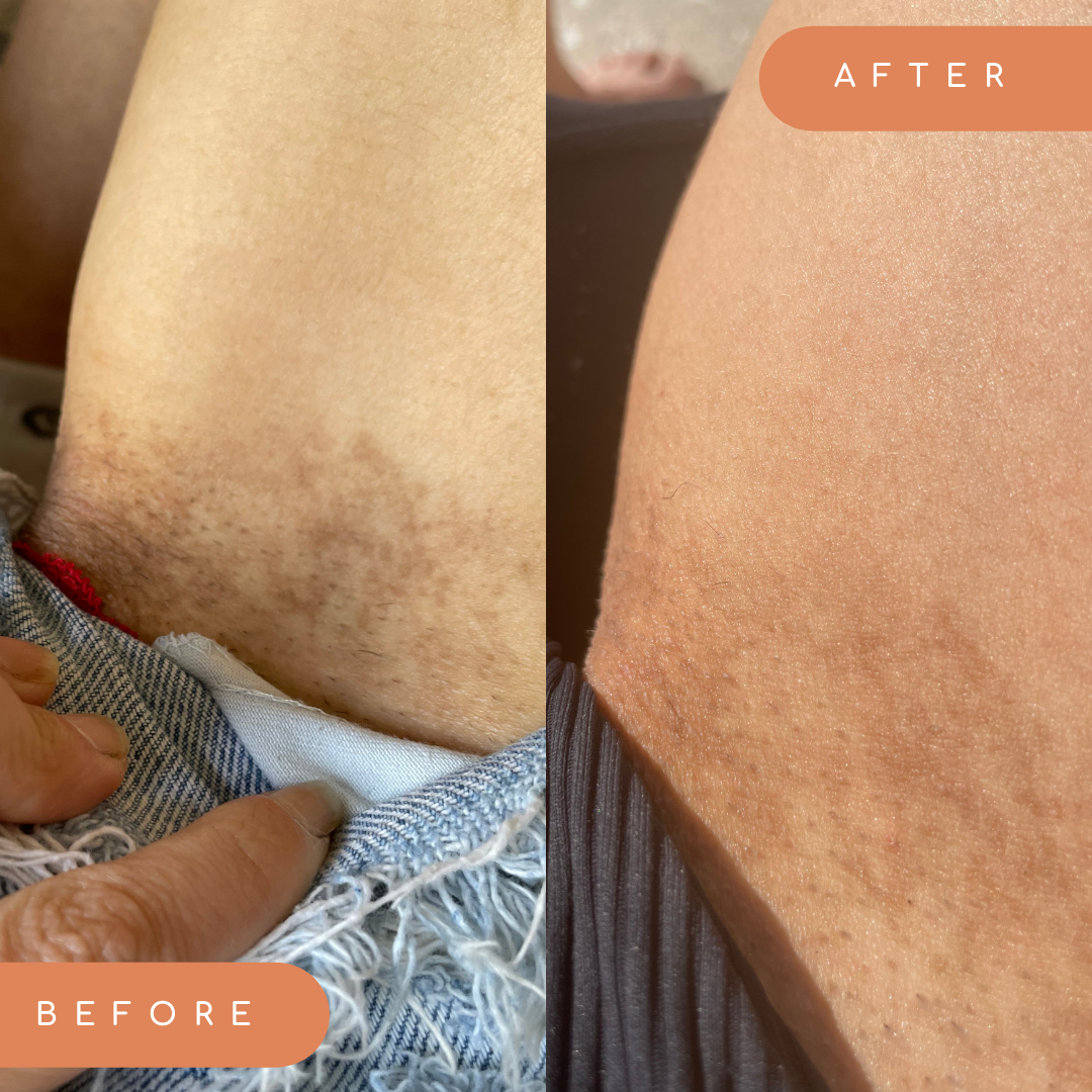 How to lighten inner thighs