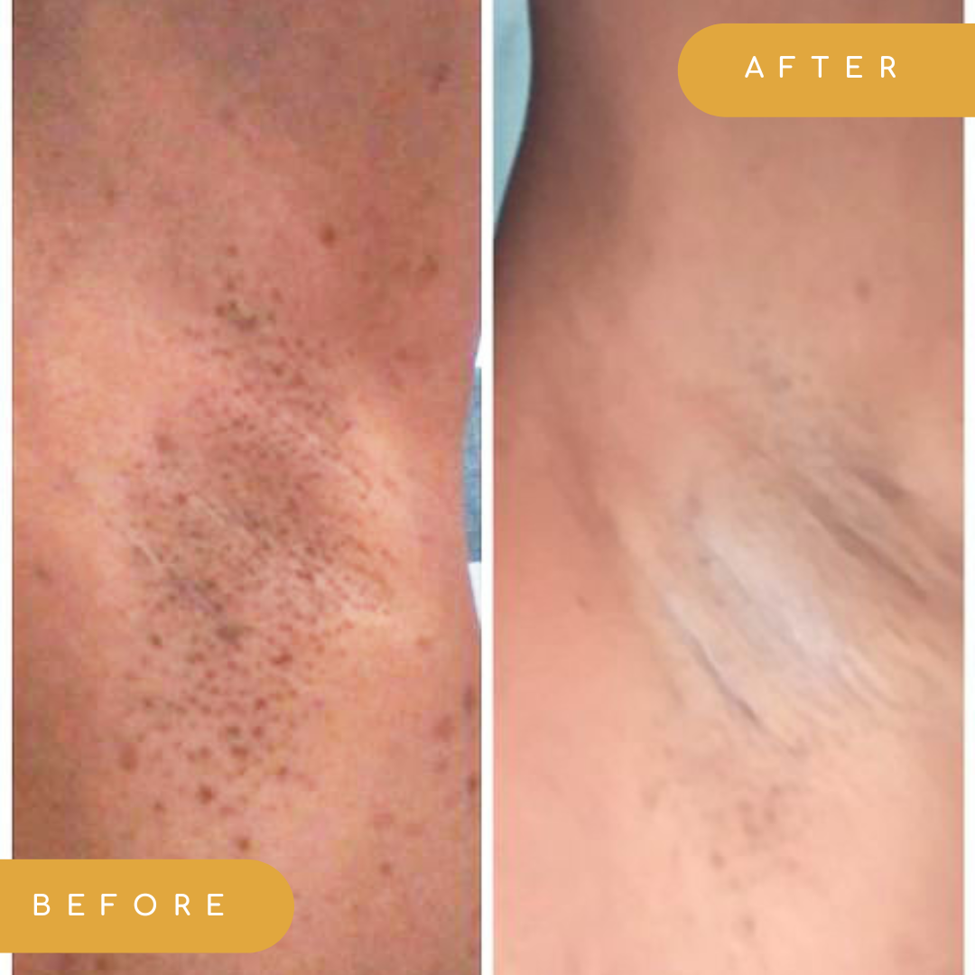 underarm results after using the original underarm brightening deodorant cream for dark armpit razor burn ingrown hairs