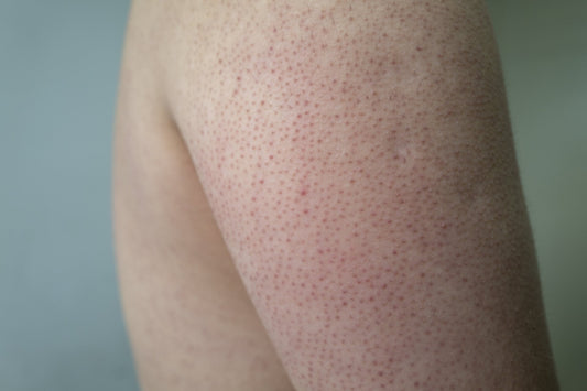 keratosis pilaris on back of arms forgotten skincare