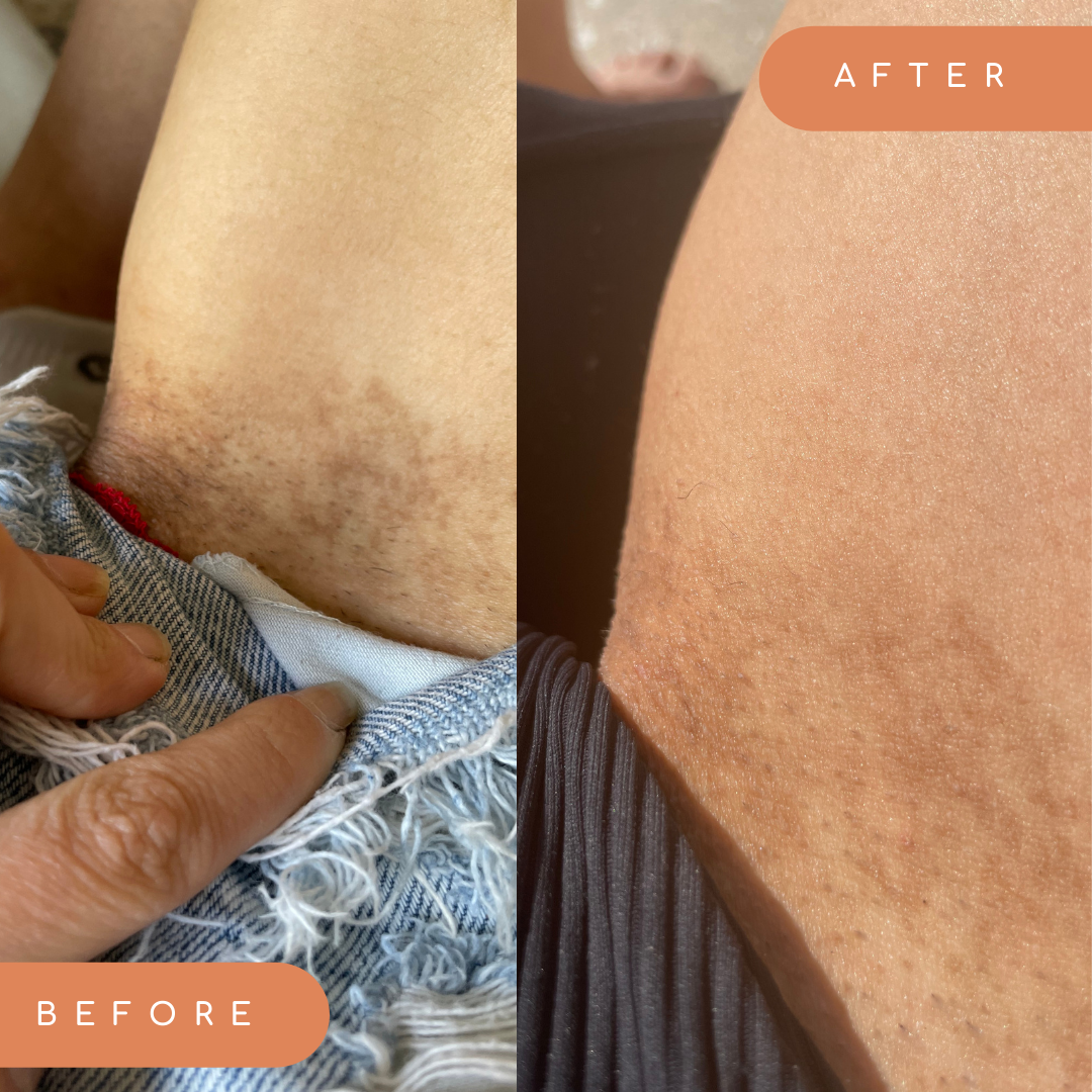 Skincare News - What Causes Dark Inner Thighs and How Can You Treat and  Prevent This Symptom? Read More:  dark-inner-thighs-and-how-can-you-treat-and-prevent-this-symptom/ - Dark  skin on the inner thighs can be