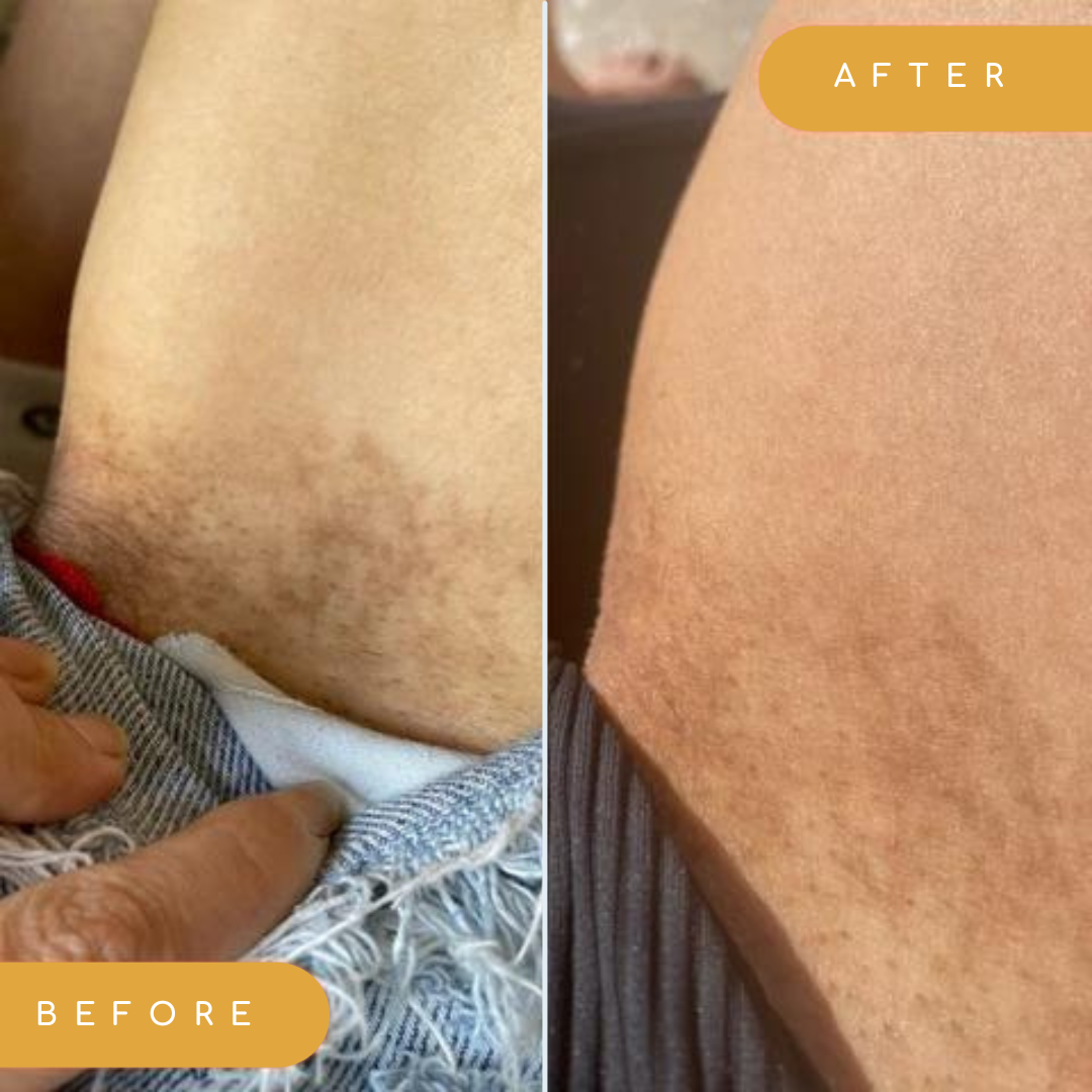 Inner thighs - deep scarring from ingrown hair cysts, stretch marks, loose  skin from weight loss. Any advice on where to begin? : r/Skincare_Addiction